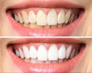 Tooth whitening