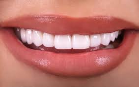 Dental Veneers