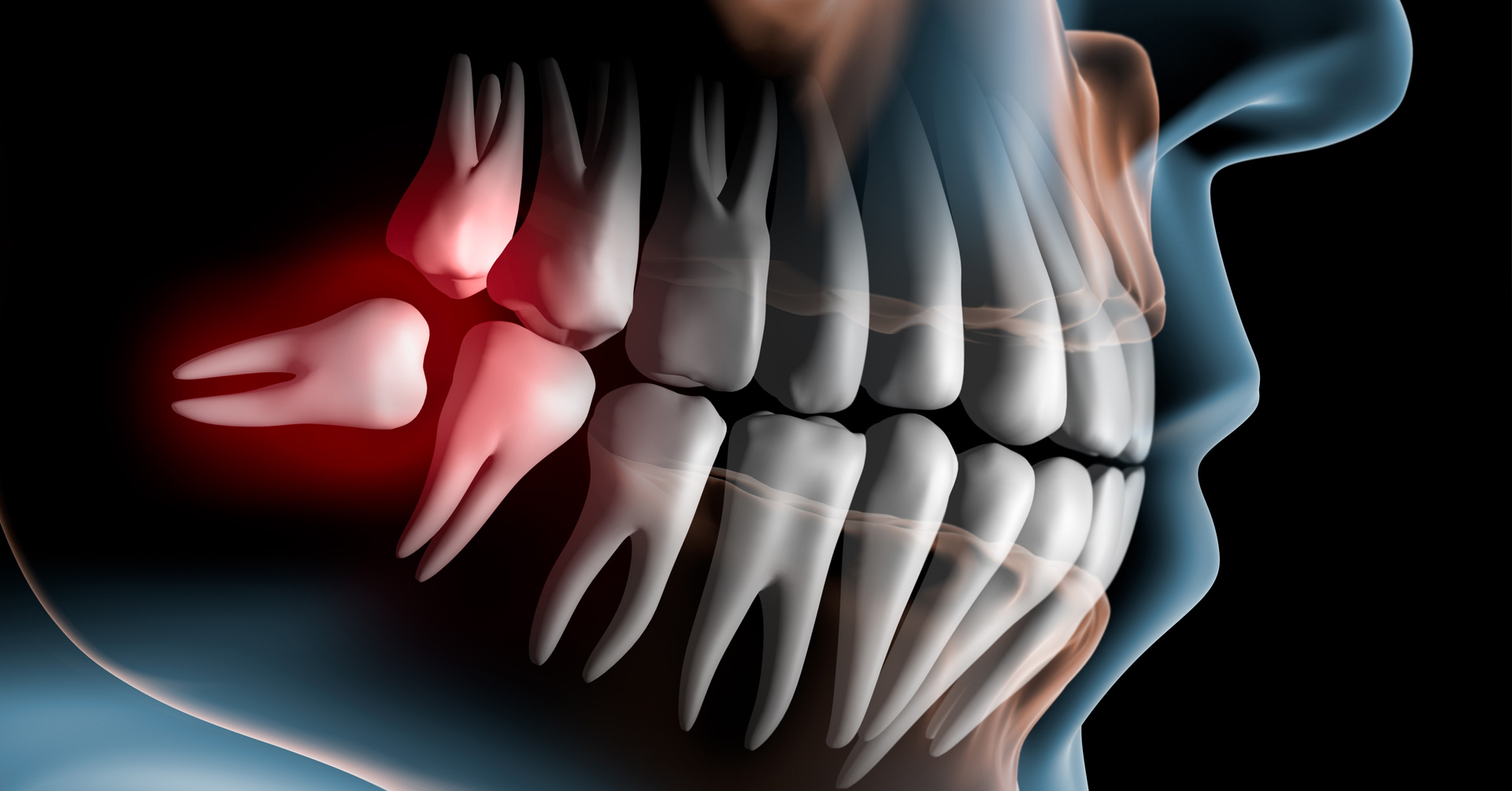 Wisdom tooth extraction